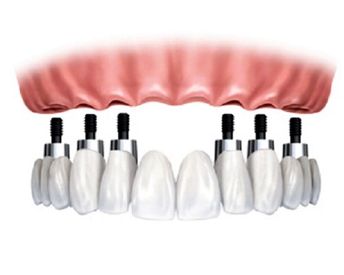 destaque Implantes dentários no maxilar superior com 6 apoios