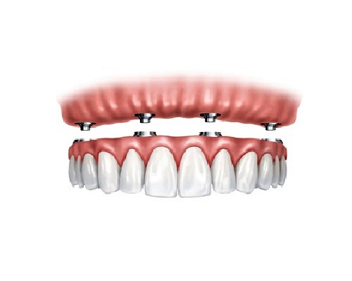 destaque Implantes dentários no maxilar superior com 4 apoios
