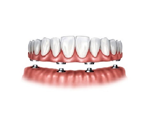 destaque Implantes dentários no maxilar inferior com 4 apoios