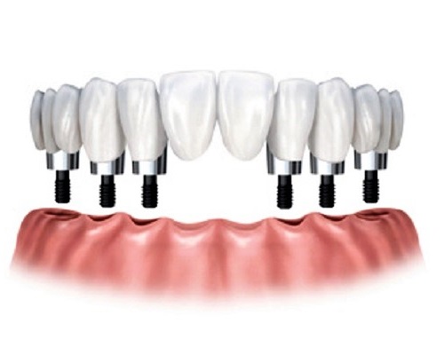 destaque Implantes dentários no maxilar inferior com 6 apoios